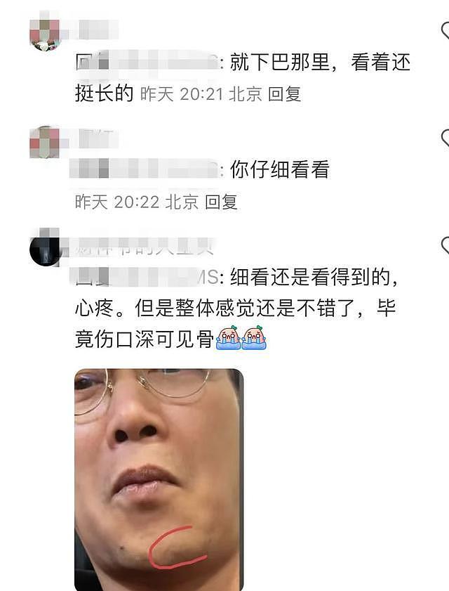 陈奕迅受伤一个月首露面，下巴缝了30针的疤痕好长，恢复情况曝光 - 9