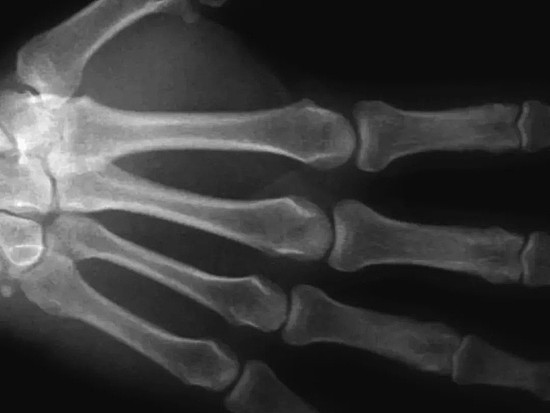 掰手指关节咔咔响，坚持50年会得关节炎吗？有科学家自己试过了 - 3