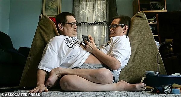 腹部相连只能轮流睡觉：世界最长寿男性连体双胞胎 68岁同时去世 - 1