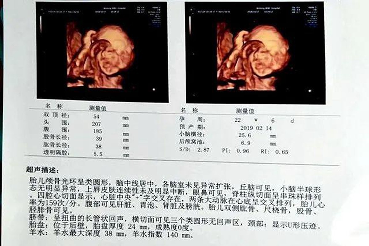 四维彩超单上的数据会告诉你胎儿是否健康，孕妈学会看不用求医生 - 7