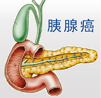 一发现就晚期！这个癌症最爱伪装成“胃痛” - 1