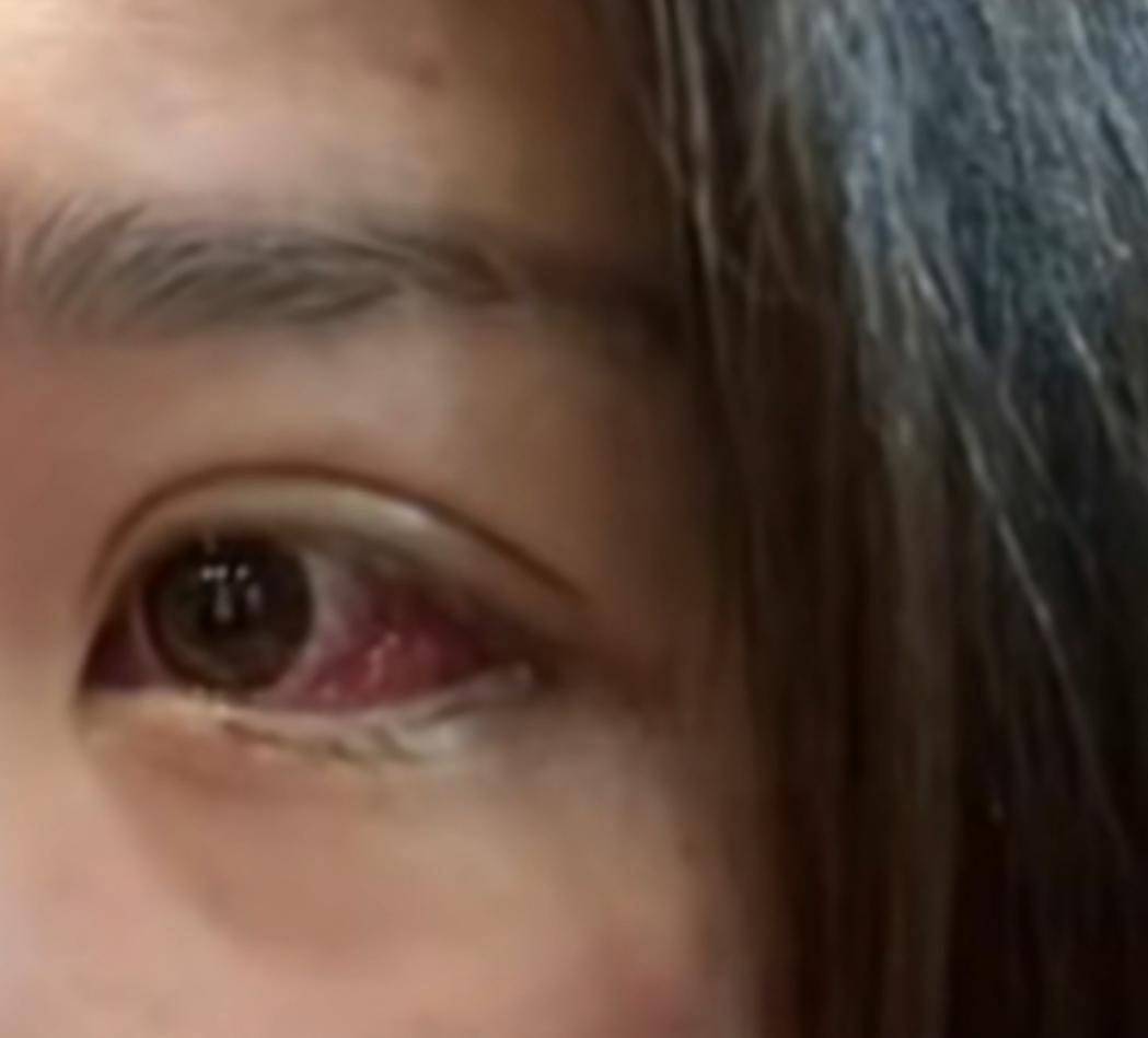 上海女足熊鑫身患肿瘤，3小时筹到50万，化疗前眼睛已有血块 - 4