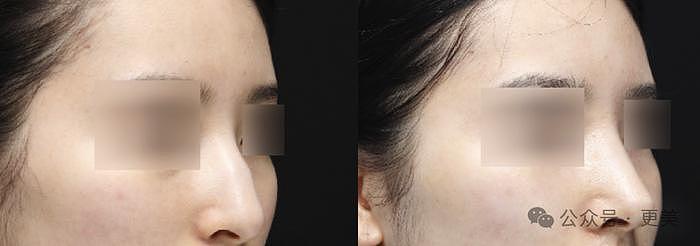 韩素希割双眼皮前，就是典型的韩式肿眼泡啊… - 45