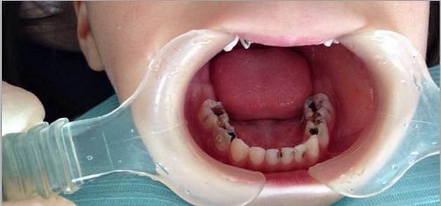 不长牙、鲨鱼齿、双排牙……孩子换牙期不注意这些问题，很容易中招 - 3