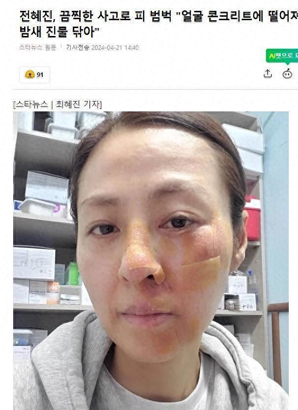 演员全慧珍，被绊倒脸部摔伤，晒出受伤照片，韩网友留言安慰 - 1