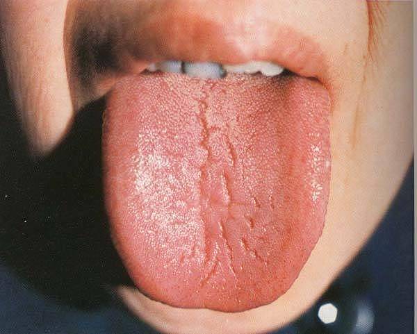 舌头出现裂口子是怎么回事？十有八九是3种情况，不要轻易忽视 - 2