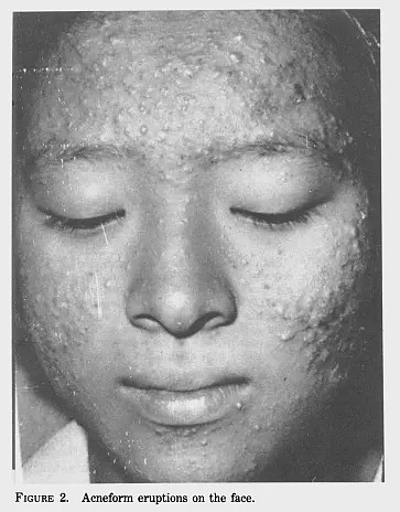 日本油症患者面部的氯痤疮。图片来源：doi.org/10.1289/ehp.59-1568099
