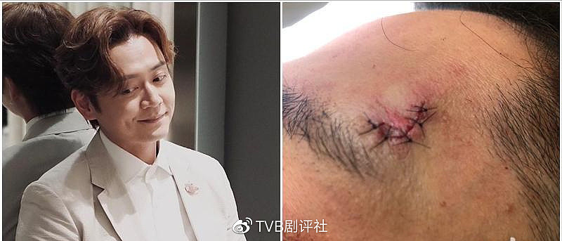 突发！TVB小生张振朗拍戏意外受伤险毁容，血流不止急送院缝七针 - 1