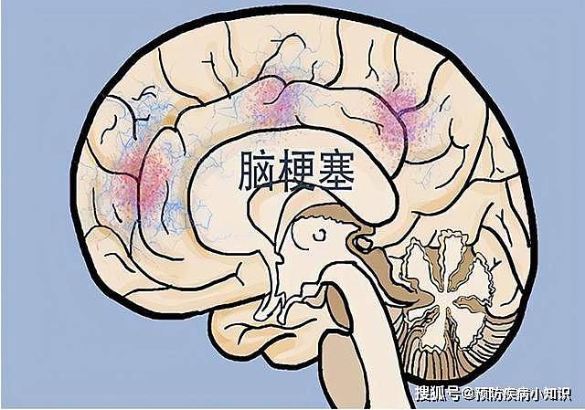 脑梗的“源头”被发现？肥肉未上榜，第一名很多老年人或爱吃 - 1