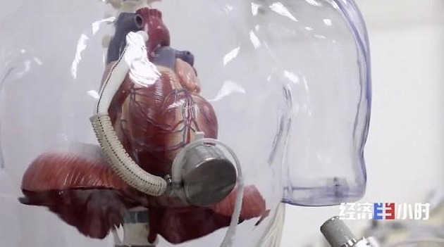 山东首例人工心脏植入患者出院，需每天充电 - 2