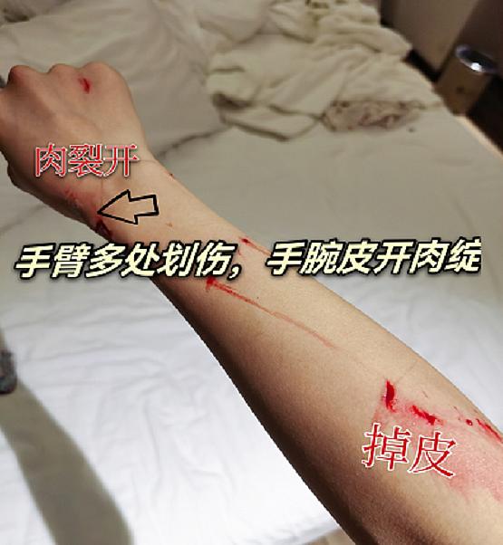 女星王钰雯在酒店遇意外，洗澡时玻璃门突然炸裂，手腕胳膊都受伤 - 5
