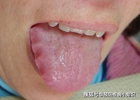 舌头是胃的“晴雨表”，胃部有疾病，舌头先知道 - 6