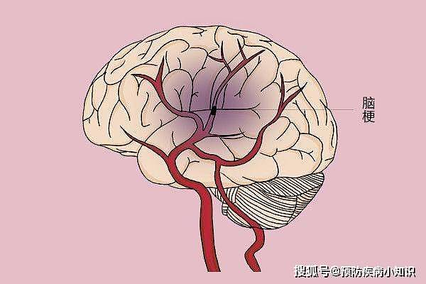 为何“脑梗”患者越来越多？医生：坚持做好5件事，或助预防脑梗 - 1