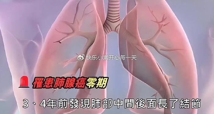 刘谦确诊肺腺癌，亲叔叔因肺癌离世，目前已完成手术在观察期 - 11