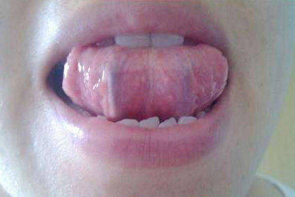 舌下有青筋，是怎么回事？青筋出现2种异常时，要注意 - 2