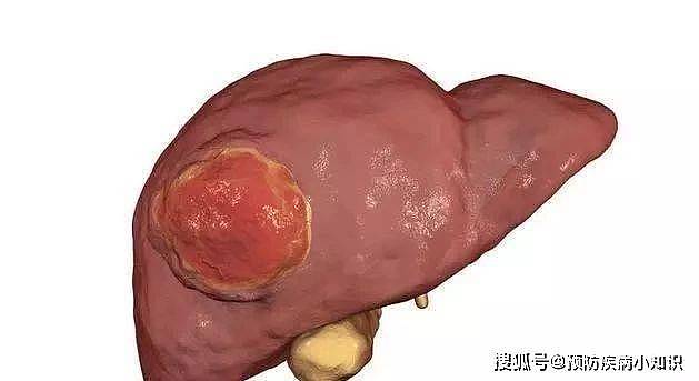 肝癌“催化剂”，医生直言：这种面条吃一口，堪比“钢丝球刮肝” - 4