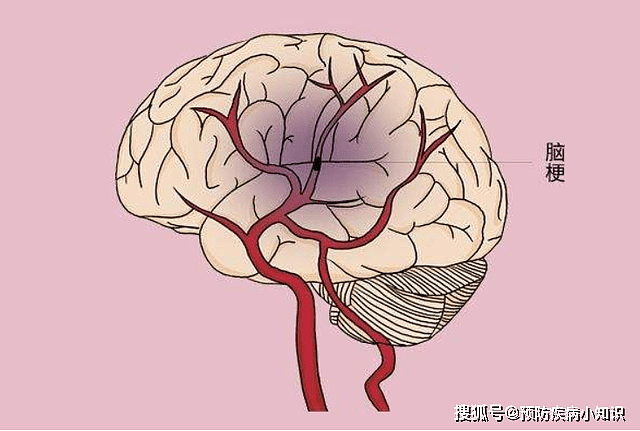 猪油是“脑梗”元凶吗？医生：不想脑梗缠身，3个潜在威胁要重视 - 1