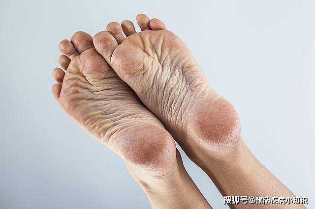 “肝癌大户”是指什么？医生提议，为了健康，希望你能管住嘴 - 3