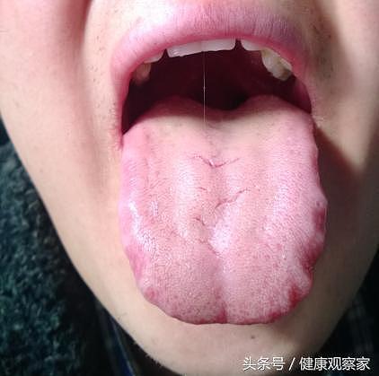 通过舌头看身体健康状态，有种舌苔很危险