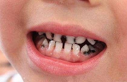 孩子会换牙，乳牙烂了无妨？这样想的父母醒醒，或影响孩子一生！