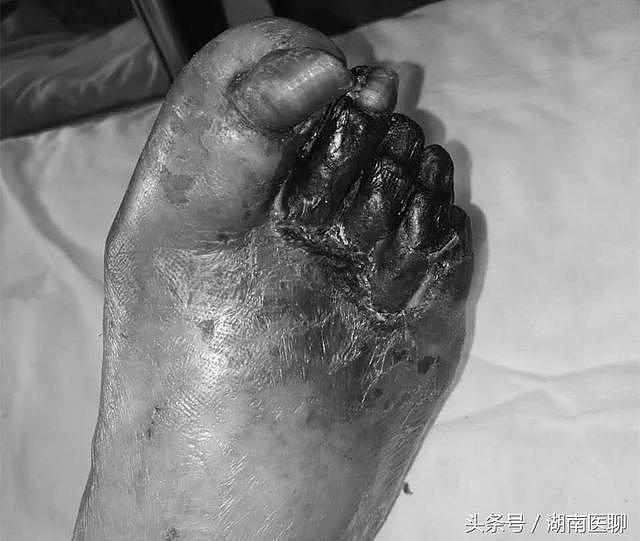 老太右脚趾长水泡，最后脚趾发黑要截肢？有这个病的人注意啦！