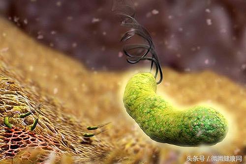 感染幽门螺杆菌，胃癌正在靠近你，怎样才能灭菌？