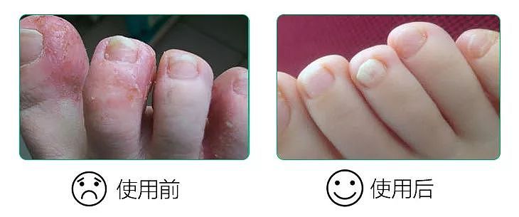 因为脚气拒绝相亲对象……“香港脚”会传染吗？能根治吗？ - 8