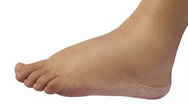 双脚是健康放大镜，这 7 个足部症状不能忽视 - 4