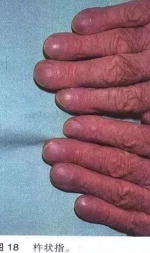 手指出现这种隆起，可能是肺癌的预兆，一定要小心！ - 1