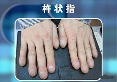 手指出现这种隆起，可能是肺癌的预兆，一定要小心！ - 2