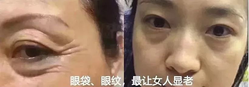 每天贴一贴，眼纹眼袋黑眼圈全不见，年轻10岁不止！ - 6