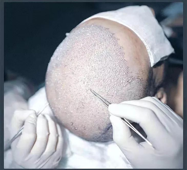 OMG | 男朋友在土耳其植发后的第三天，我想到了分手 - 21