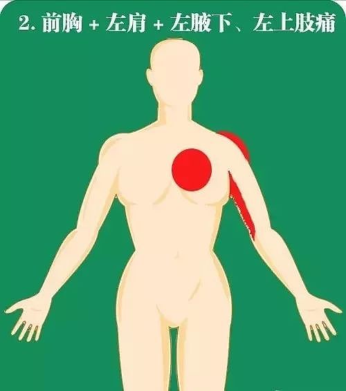 急性心梗的10个常见疼痛部位及图解！ - 2