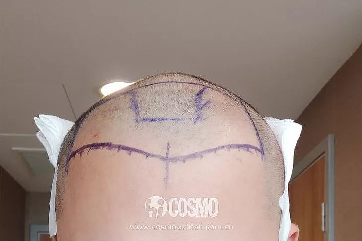 OMG | 男朋友在土耳其植发后的第三天，我想到了分手 - 19
