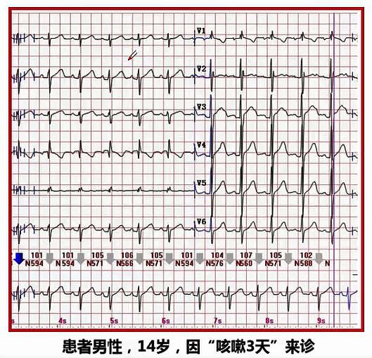 心电图竟可以像心超一样识别先天性心脏病？ - 2