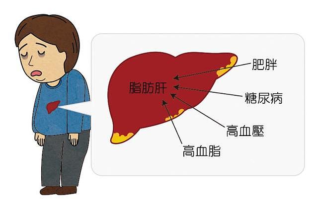 肥胖、酒精、不良饮食习惯……极易伤肝！这个病连累2亿多中国人