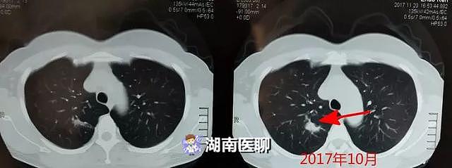 47岁大姐体检，肺部发现小结节， 一年后竟现癌变