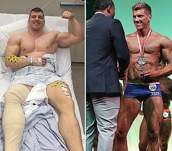 26岁健美运动员小腿静脉爆裂，不得不远离撸铁生涯
