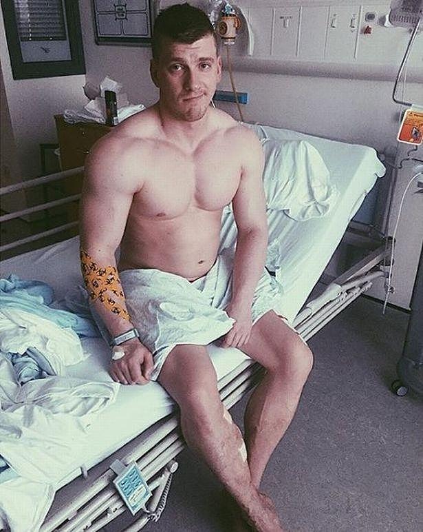 26岁健美运动员小腿静脉爆裂，不得不远离撸铁生涯