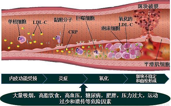 没高血压、糖尿病、高血脂，就抽点烟，年纪轻轻就中风了呢？